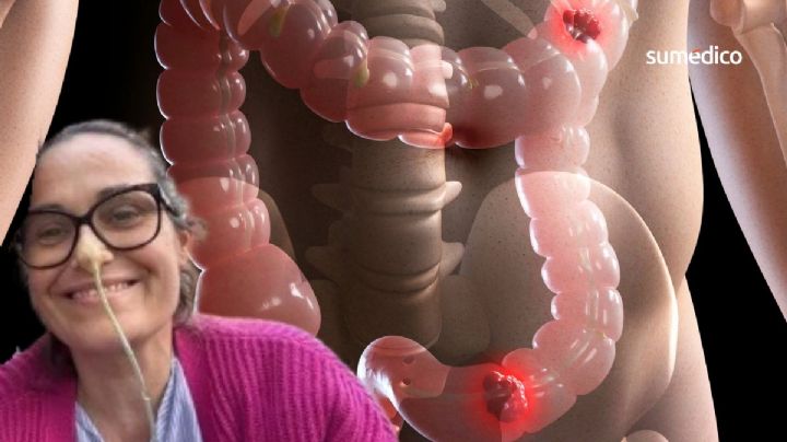 ‘Creí que eran síntomas de perimenopausia, pero tenía cáncer de intestino’
