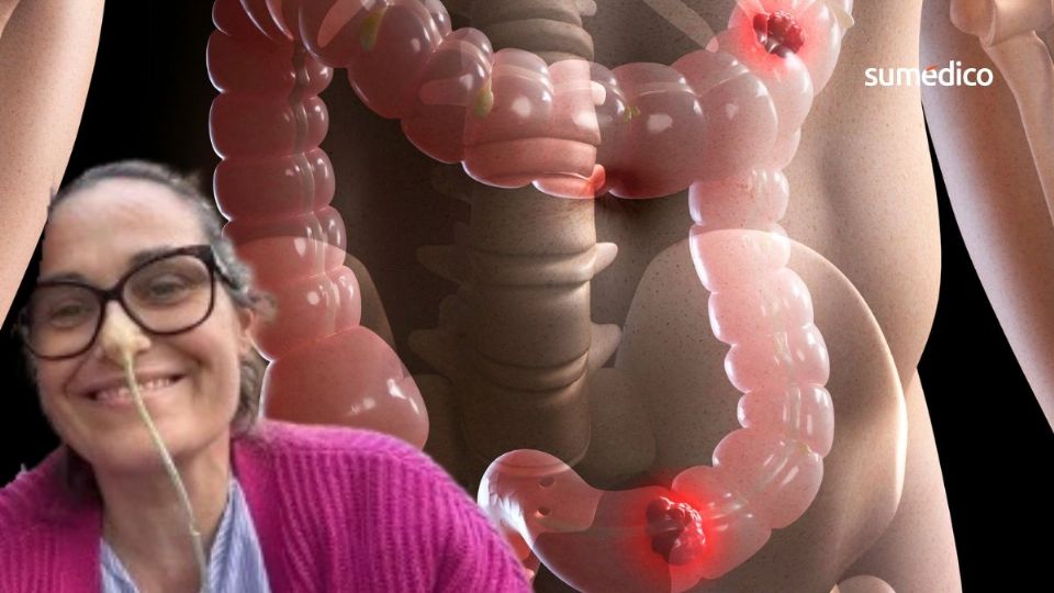 El cáncer intestinal que no se detecta a tiempo puede ser mortal.