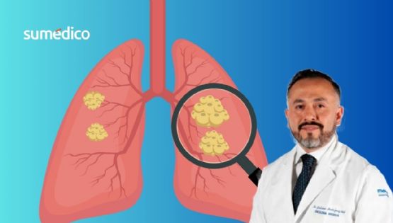 Oncólogo alerta los hábitos que NO sabías que causan cáncer de pulmón
