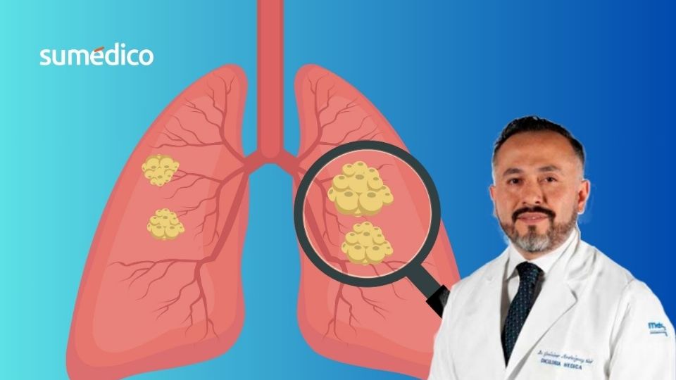 El ´cancer de pulmón comprende un grupo de tumores
