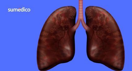 ¿Cáncer de pulmón sin fumar? El nuevo reto de los científicos