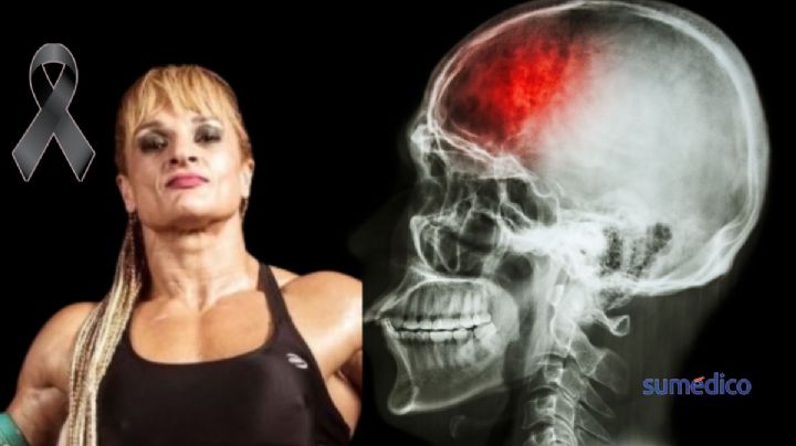 ¿Qué causa un infarto cerebral como el que sufrió la boxeadora Alejandra ‘Locomotora’ Oliveras?