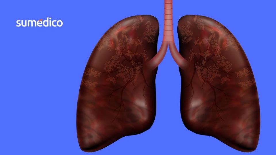 El cáncer de pulmón es el más mortal en Estados Unidos