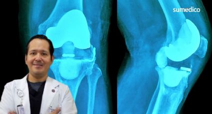 ¿Necesitas una cirugía de reemplazo de rodilla?