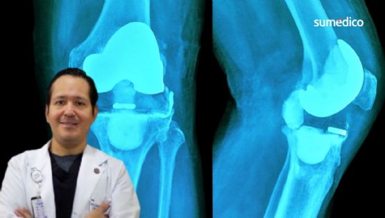 ¿Necesitas una cirugía de reemplazo de rodilla?
