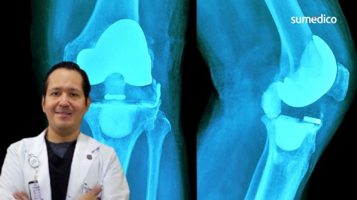 ¿Necesitas una cirugía de reemplazo de rodilla?