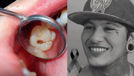 Joven muere por infección en una muela: el peligro de ignorar el dolor dental
