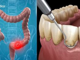 ¿Tienes este problema en las encías? Podrías tener mayor riesgo de cáncer colorrectal