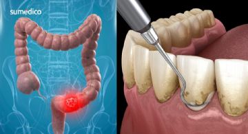 ¿Tienes este problema en las encías? Podrías tener mayor riesgo de cáncer colorrectal