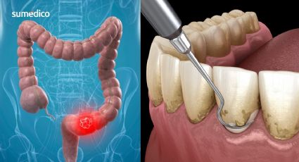 ¿Tienes este problema en las encías? Podrías tener mayor riesgo de cáncer colorrectal