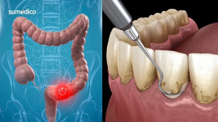 ¿Tienes este problema en las encías? Podrías tener mayor riesgo de cáncer colorrectal
