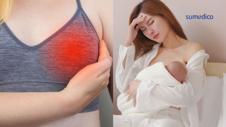 Mastitis: Síntomas que NO debes ignorar de esta infección común en la lactancia
