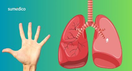 Un síntoma en los dedos que manifiesta enfermedad pulmonar rara