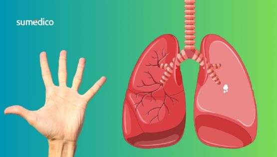 Un síntoma en los dedos que manifiesta enfermedad pulmonar rara