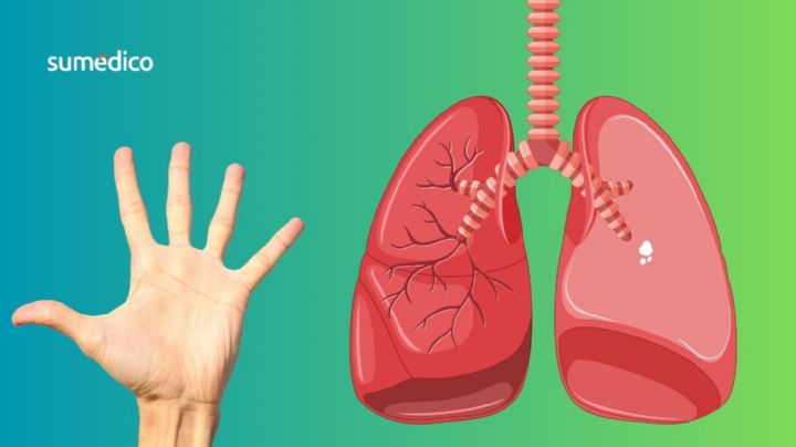 Un síntoma en los dedos que manifiesta enfermedad pulmonar rara