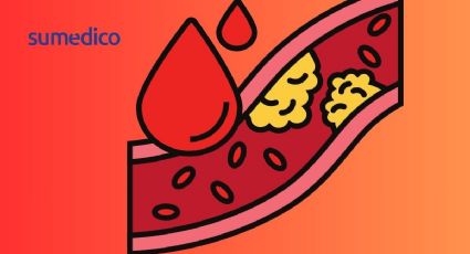 3 causas por las que tu colesterol está alto aunque no comas grasas, según cardiólogo