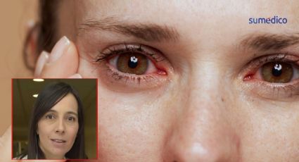 La sífilis también puede afectar los ojos