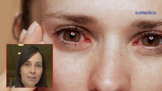 La sífilis también puede afectar los ojos
