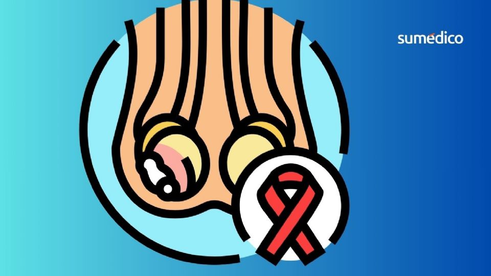 El cáncer testicular es común en población juvenil de entre 15 y 35 años