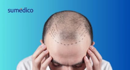 ¿Te atreverías a hacerte un trasplante capilar? Conoce los riesgos antes de decidir