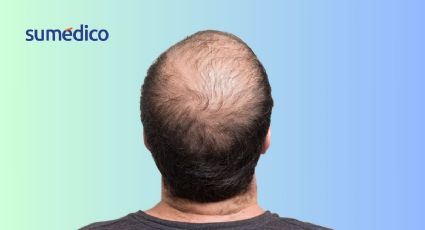 4 hacks para tratar la caída del cabello