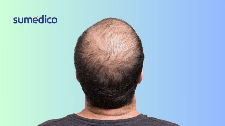 4 hacks para tratar la caída del cabello
