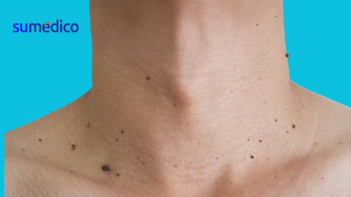 ¿Sirve el vinagre de manzana para quitar verrugas en piel? Esto sabemos