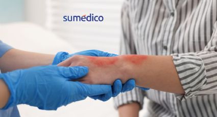 Cómo actuar inmediatamente después de una quemadura