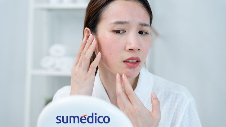 ¿Qué es la dermatitis seborreica?