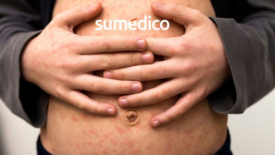 Se dio a conocer el panorama de sarampión en México, siendo Jalisco y Chiapas los estados con más contagios