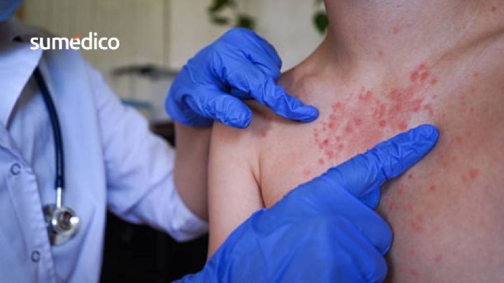 ¿Hay un caso sospechoso de sarampión en tu escuela o trabajo? Esto es lo que debes hacer