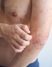 Foto descriptiva de: Adultos jóvenes, de los más afectados por el sarampión en México