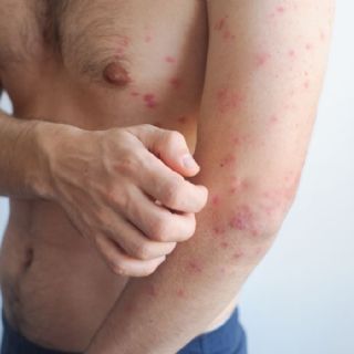 Adultos jóvenes, de los más afectados por el sarampión en México