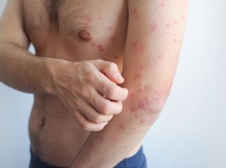 Adultos jóvenes, de los más afectados por el sarampión en México