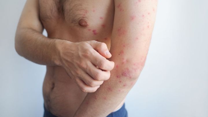 Adultos jóvenes, de los más afectados por el sarampión en México