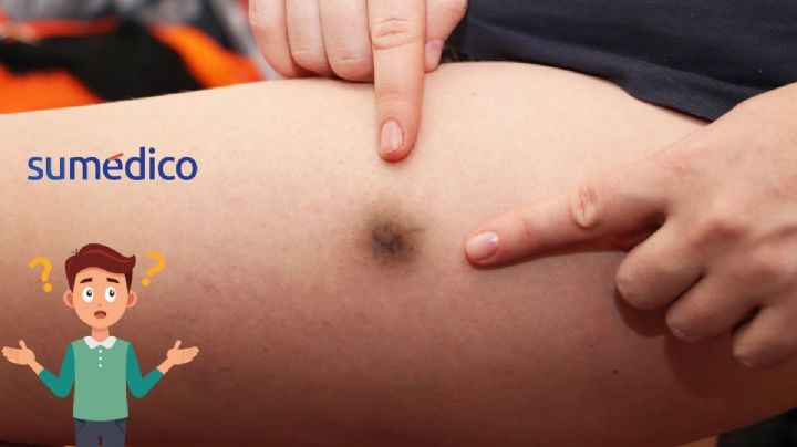 ¿Por qué salen moretones sin razón aparente?