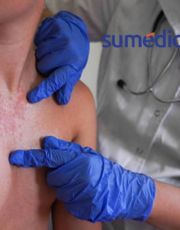 Foto descriptiva de: ¿Cuándo se quitan las ronchas del sarampión?