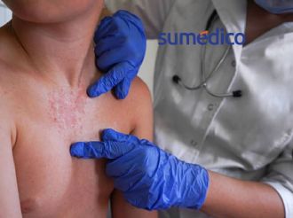 ¿Cuándo se quitan las ronchas del sarampión?