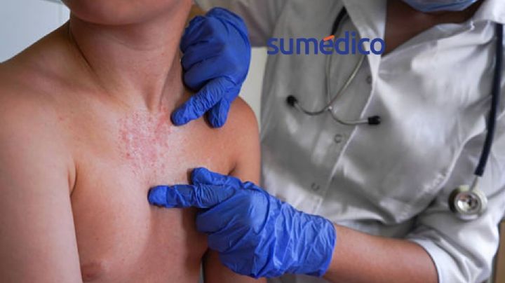 ¿Cuándo se quitan las ronchas del sarampión?