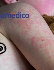 Foto descriptiva de: ¿Cómo saber si tuviste sarampión de niño?