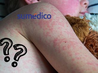 ¿Cómo saber si tuviste sarampión de niño?