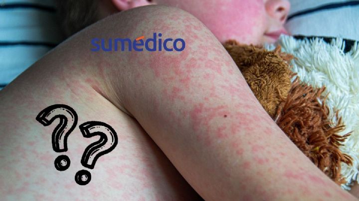 ¿Cómo saber si tuviste sarampión de niño?