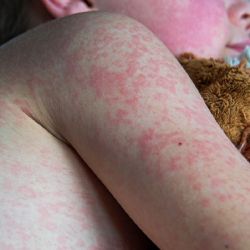 Sarampión, el regreso de un viejo enemigo del mundo y México