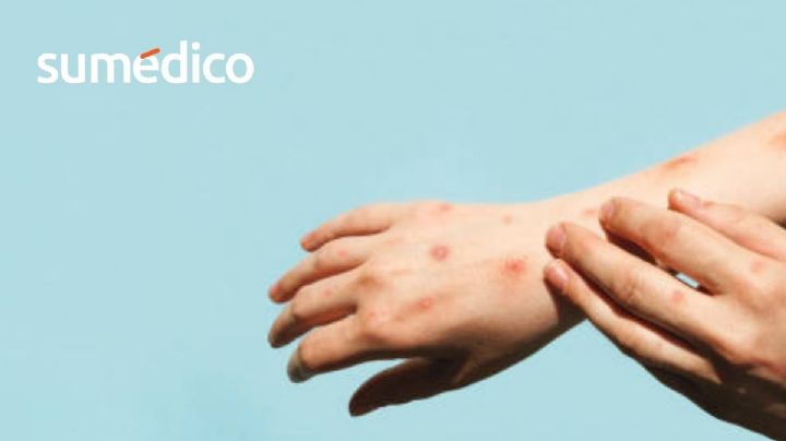 ¿Cómo distinguir entre sarampión y varicela?