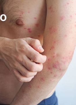 Foto descriptiva de: Sarampión: por qué contagiarse de adulto puede ser más grave