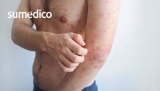 Sarampión: por qué contagiarse de adulto puede ser más grave