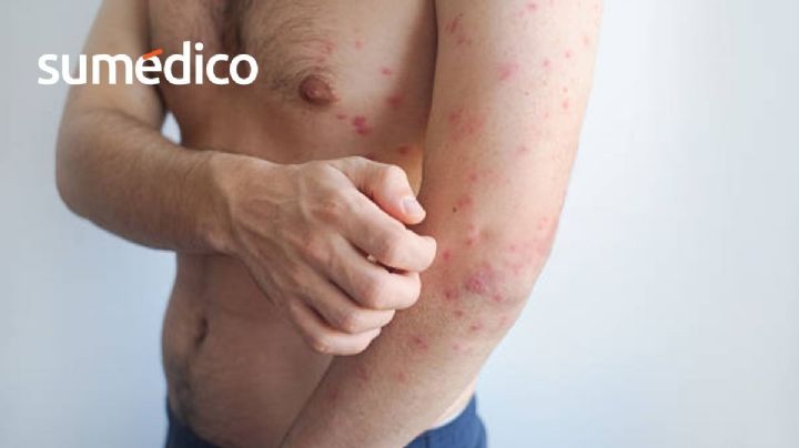 Sarampión: por qué contagiarse de adulto puede ser más grave