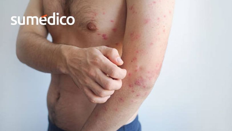 Sarampión: por qué contagiarse de adulto puede ser más grave