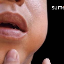 ¿A qué edad se aplica la vacuna contra las paperas en México?