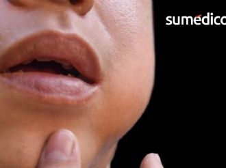 ¿A qué edad se aplica la vacuna contra las paperas en México?